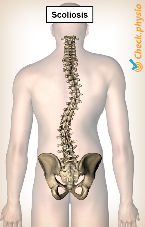 back-scoliosis-curvature-spine-spinal-column